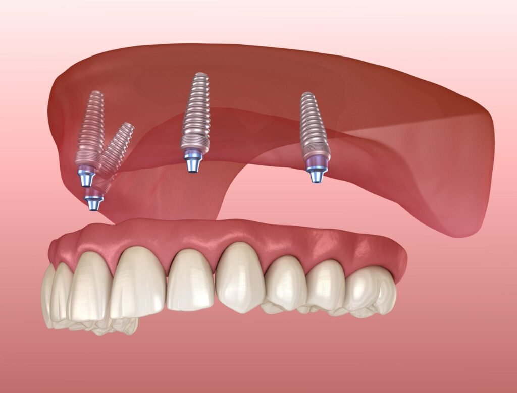 What Are Dental Implants and Dentures, and What Are Their Benefits?